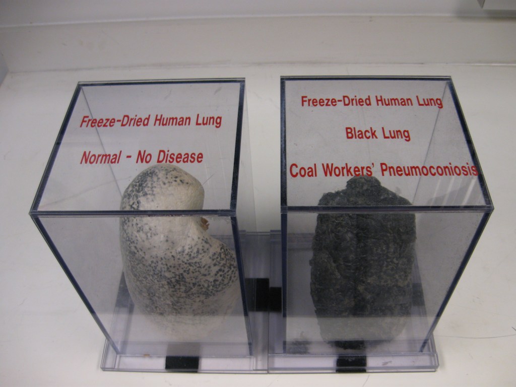 A display at the National Institute for Occupational Safety and Health in Morgantown, West Virginia, compares a normal lung to a lung riddled with fibrotic tissue from black lung disease.